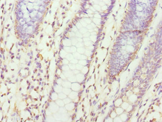 CXXC4 Antibody - Immunohistochemistry of paraffin-embedded human colon cancer at dilution 1:100