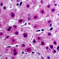 CYB5A / Cytochrome b5 Antibody - Immunohistochemical analysis of Cytochrome b5A staining in human liver cancer formalin fixed paraffin embedded tissue section. The section was pre-treated using heat mediated antigen retrieval with sodium citrate buffer (pH 6.0). The section was then incubated with the antibody at room temperature and detected using an HRP conjugated compact polymer system. AEC was used as the chromogen. The section was then counterstained with hematoxylin and mounted with DPX.