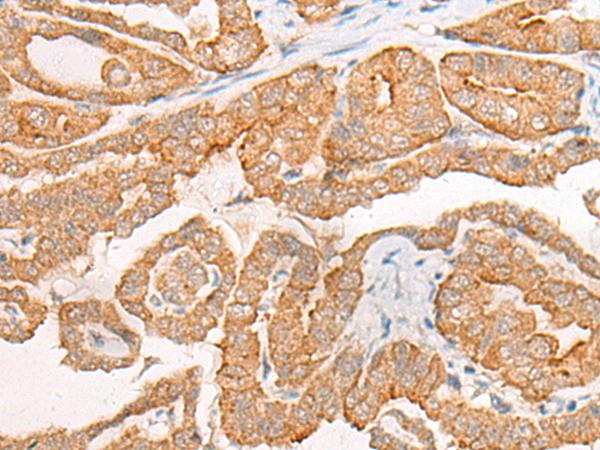 CYB5D1 Antibody - Immunohistochemistry of paraffin-embedded Human thyroid cancer tissue  using CYB5D1 Polyclonal Antibody at dilution of 1:45(×200)