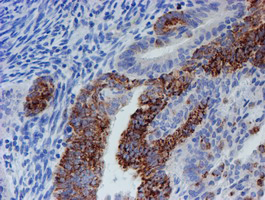 CYB5R1 Antibody - IHC of paraffin-embedded Adenocarcinoma of Human endometrium tissue using anti-CYB5R1 mouse monoclonal antibody. (Heat-induced epitope retrieval by 10mM citric buffer, pH6.0, 100C for 10min).