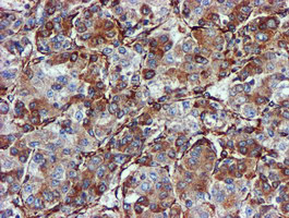 CYB5R3 / B5R Antibody - IHC of paraffin-embedded Carcinoma of Human liver tissue using anti-CYB5R3 mouse monoclonal antibody. (Heat-induced epitope retrieval by 10mM citric buffer, pH6.0, 100C for 10min).