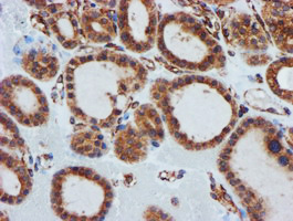 CYB5R3 / B5R Antibody - IHC of paraffin-embedded Carcinoma of Human thyroid tissue using anti-CYB5R3 mouse monoclonal antibody. (Heat-induced epitope retrieval by 10mM citric buffer, pH6.0, 100C for 10min).