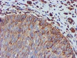 CYB5R3 / B5R Antibody - IHC of paraffin-embedded Carcinoma of Human bladder tissue using anti-CYB5R3 mouse monoclonal antibody. (Heat-induced epitope retrieval by 10mM citric buffer, pH6.0, 100C for 10min).