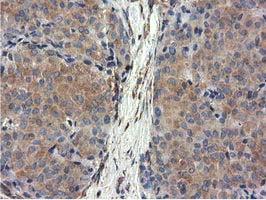 CYB5R3 / B5R Antibody - Immunohistochemical staining of paraffin-embedded Adenocarcinoma of Human breast tissue using anti-CYB5R3 mouse monoclonal antibody.