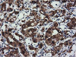CYB5R3 / B5R Antibody - Immunohistochemical staining of paraffin-embedded Carcinoma of Human kidney tissue using anti-CYB5R3 mouse monoclonal antibody.
