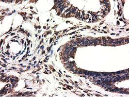 CYB5R3 / B5R Antibody - Immunohistochemical staining of paraffin-embedded Adenocarcinoma of Human endometrium tissue using anti-CYB5R3 mouse monoclonal antibody.