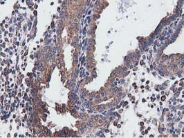 CYB5R3 / B5R Antibody - Immunohistochemical staining of paraffin-embedded Carcinoma of Human prostate tissue using anti-CYB5R3 mouse monoclonal antibody.