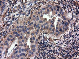 CYB5R3 / B5R Antibody - Immunohistochemical staining of paraffin-embedded Carcinoma of Human bladder tissue using anti-CYB5R3 mouse monoclonal antibody.
