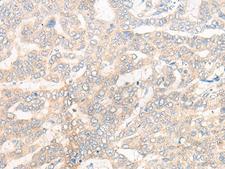 CYB5R3 / B5R Antibody - Immunohistochemistry of paraffin-embedded Human liver cancer tissue  using CYB5R3 Polyclonal Antibody at dilution of 1:50(×200)