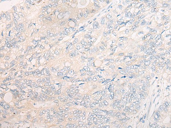 CYB5R3 / B5R Antibody - Immunohistochemistry of paraffin-embedded Human gastric cancer tissue  using CYB5R3 Polyclonal Antibody at dilution of 1:50(×200)