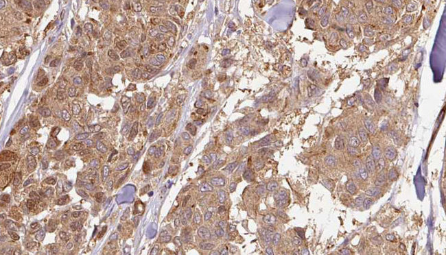 CYB5R4 Antibody - 1:100 staining human Melanoma tissue by IHC-P. The sample was formaldehyde fixed and a heat mediated antigen retrieval step in citrate buffer was performed. The sample was then blocked and incubated with the antibody for 1.5 hours at 22°C. An HRP conjugated goat anti-rabbit antibody was used as the secondary.