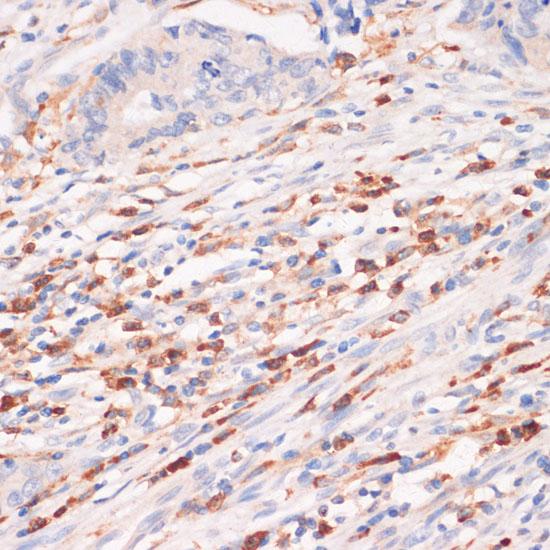 CYBA / p22phox Antibody - Immunohistochemistry of paraffin-embedded Human colon carcinoma using CYBA Polyclonal Antibody at dilution of 1:100 (40x lens).