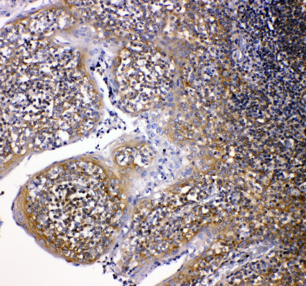 CYBB / NOX2 / gp91phox Antibody - NOX2 / gp91phox antibody. IHC(P): Human Intestinal Cancer Tissue.