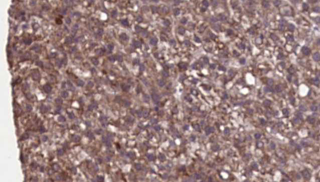 CYBB / NOX2 / gp91phox Antibody - 1:100 staining human liver carcinoma tissues by IHC-P. The sample was formaldehyde fixed and a heat mediated antigen retrieval step in citrate buffer was performed. The sample was then blocked and incubated with the antibody for 1.5 hours at 22°C. An HRP conjugated goat anti-rabbit antibody was used as the secondary.