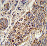 CYC1 / Cytochrome C-1 Antibody - CYC1 Antibody immunohistochemistry of formalin-fixed and paraffin-embedded human lung carcinoma followed by peroxidase-conjugated secondary antibody and DAB staining.