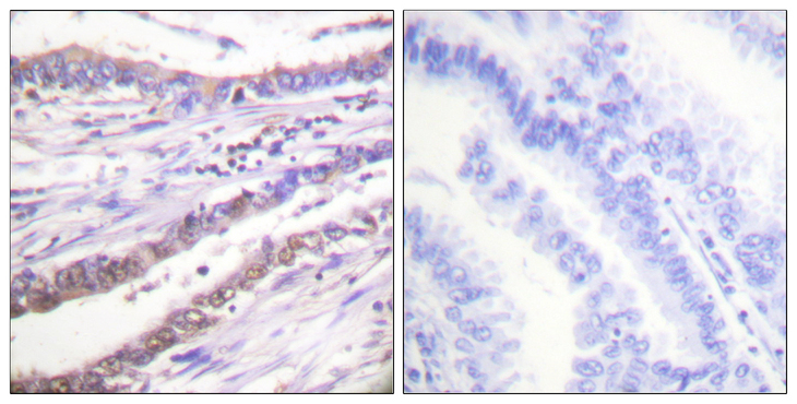 Cyclin A Antibody - Immunohistochemistry analysis of paraffin-embedded human lung carcinoma tissue, using Cyclin A Antibody. The picture on the right is blocked with the synthesized peptide.