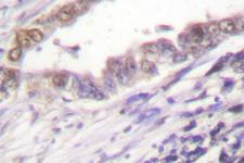 Cyclin A Antibody - IHC of Cyclin A (W250) pAb in paraffin-embedded human lung carcinoma tissue.
