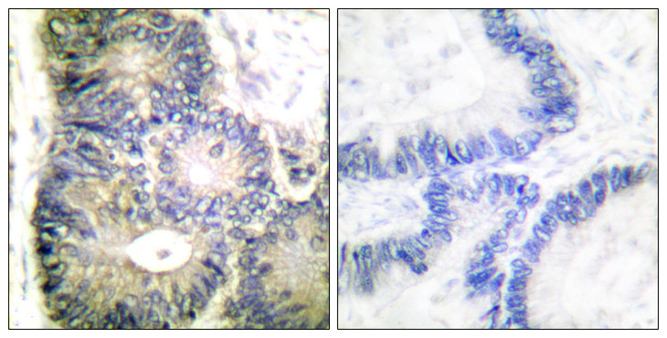 CYCS / Cytochrome c Antibody - Immunohistochemistry analysis of paraffin-embedded human colon carcinoma tissue, using Cytochrome c Antibody. The picture on the right is blocked with the synthesized peptide.