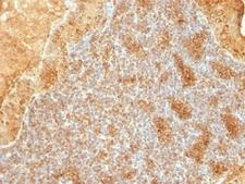 CYCS / Cytochrome c Antibody - Formalin-fixed, paraffin-embedded human salivary tumor stained with Cytochrome C antibody (SPM389).  This image was taken for the unmodified form of this product. Other forms have not been tested.
