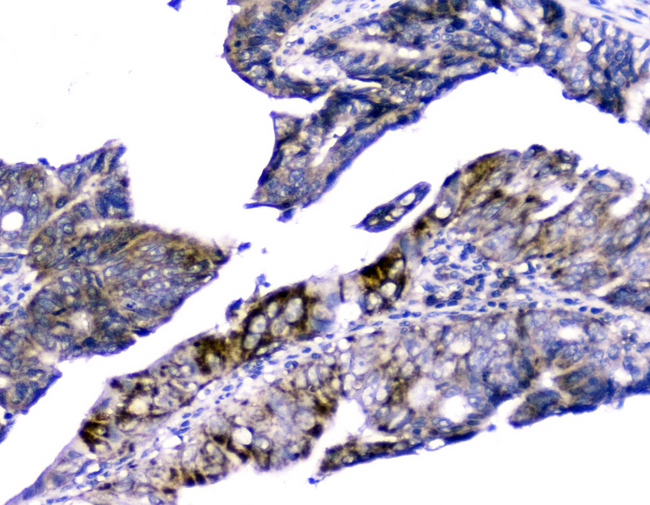 CYCS / Cytochrome c Antibody - IHC analysis of Cytochrome C using anti-Cytochrome C antibody. Cytochrome C was detected in paraffin-embedded section of human intestinal cancer tissue. Heat mediated antigen retrieval was performed in citrate buffer (pH6, epitope retrieval solution) for 20 mins. The tissue section was blocked with 10% goat serum. The tissue section was then incubated with 2µg/ml mouse anti-Cytochrome C antibody overnight at 4°C. Biotinylated goat anti-mouse IgG was used as secondary antibody and incubated for 30 minutes at 37°C. The tissue section was developed using Strepavidin-Biotin-Complex (SABC) with DAB as the chromogen.