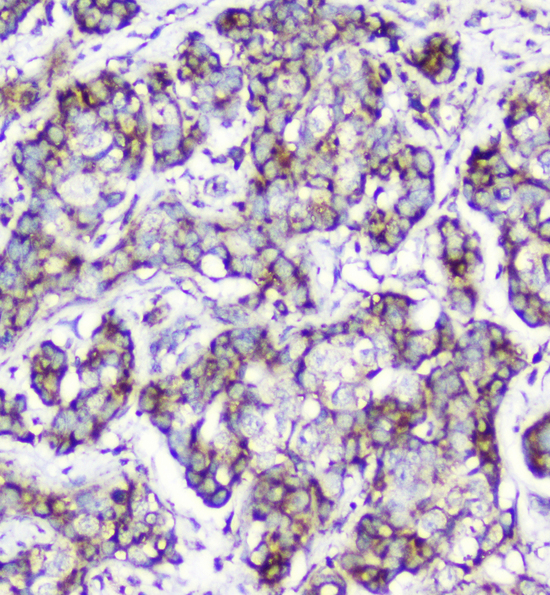 CYCS / Cytochrome c Antibody - IHC analysis of Cytochrome C using anti-Cytochrome C antibody. Cytochrome C was detected in paraffin-embedded section of human mammary cancer tissue. Heat mediated antigen retrieval was performed in citrate buffer (pH6, epitope retrieval solution) for 20 mins. The tissue section was blocked with 10% goat serum. The tissue section was then incubated with 2µg/ml mouse anti-Cytochrome C antibody overnight at 4°C. Biotinylated goat anti-mouse IgG was used as secondary antibody and incubated for 30 minutes at 37°C. The tissue section was developed using Strepavidin-Biotin-Complex (SABC) with DAB as the chromogen.