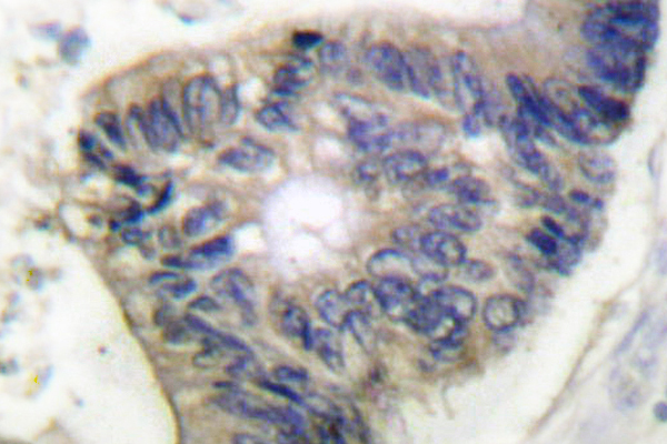 CYCS / Cytochrome c Antibody - IHC of Cytochrome c (H19) pAb in paraffin-embedded human colon carcinoma tissue.