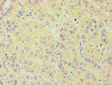 CYGB / Cytoglobin Antibody - Immunohistochemistry of paraffin-embedded human liver cancer using antibody at 1:100 dilution.