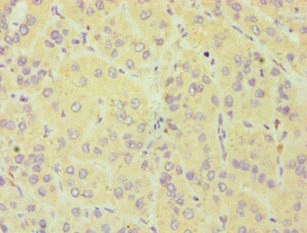 CYGB / Cytoglobin Antibody - Immunohistochemistry of paraffin-embedded human liver cancer using CYGB Antibody at dilution of 1:100
