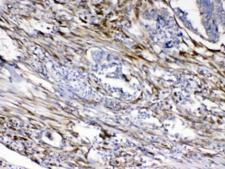 CYGB / Cytoglobin Antibody - IHC testing of FFPE human intestinal cancer tissue with Cytoglobin antibody at 1ug/ml. Required HIER: steam section in pH6 citrate buffer for 20 min and allow to cool prior to testing.