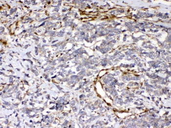 CYGB / Cytoglobin Antibody - IHC testing of FFPE human lung cancer tissue with Cytoglobin antibody at 1ug/ml. Required HIER: steam section in pH6 citrate buffer for 20 min and allow to cool prior to testing.