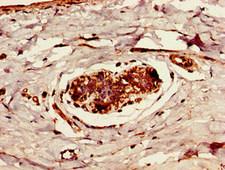 CYLD Antibody - Immunohistochemistry image of paraffin-embedded human breast cancer at a dilution of 1:100