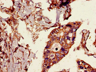 CYLD Antibody - Immunohistochemistry image of paraffin-embedded human pancreatic cancer at a dilution of 1:100