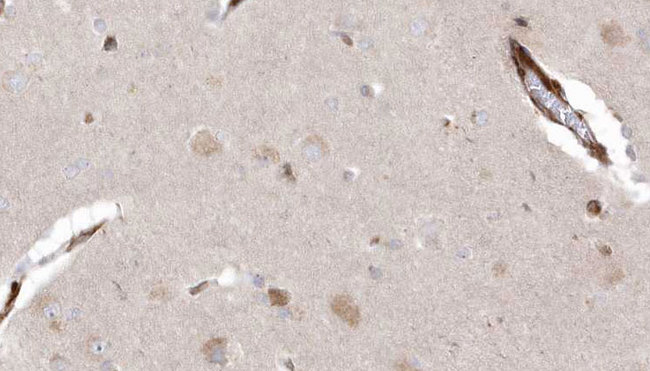 CYLD Antibody - 1:100 staining human brain carcinoma tissue by IHC-P. The sample was formaldehyde fixed and a heat mediated antigen retrieval step in citrate buffer was performed. The sample was then blocked and incubated with the antibody for 1.5 hours at 22°C. An HRP conjugated goat anti-rabbit antibody was used as the secondary.