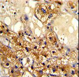 CYP-M / CYP20A1 Antibody - Formalin-fixed and paraffin-embedded human hepatocarcinoma with CYP20A1 Antibody , which was peroxidase-conjugated to the secondary antibody, followed by DAB staining. This data demonstrates the use of this antibody for immunohistochemistry; clinical relevance has not been evaluated.