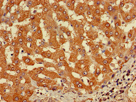 CYP-M / CYP20A1 Antibody - Immunohistochemistry of paraffin-embedded human liver cancer at dilution of 1:100