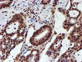 CYP17 / CYP17A1 Antibody - IHC of paraffin-embedded Adenocarcinoma of Human colon tissue using anti-CYP17A1 mouse monoclonal antibody. (Heat-induced epitope retrieval by 10mM citric buffer, pH6.0, 100C for 10min).