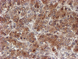 CYP17 / CYP17A1 Antibody - IHC of paraffin-embedded Carcinoma of Human liver tissue using anti-CYP17A1 mouse monoclonal antibody. (Heat-induced epitope retrieval by 10mM citric buffer, pH6.0, 100C for 10min).