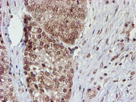 CYP17 / CYP17A1 Antibody - IHC of paraffin-embedded Adenocarcinoma of Human ovary tissue using anti-CYP17A1 mouse monoclonal antibody. (Heat-induced epitope retrieval by 10mM citric buffer, pH6.0, 100C for 10min).