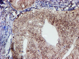 CYP17 / CYP17A1 Antibody - IHC of paraffin-embedded Adenocarcinoma of Human endometrium tissue using anti-CYP17A1 mouse monoclonal antibody. (Heat-induced epitope retrieval by 10mM citric buffer, pH6.0, 100C for 10min).