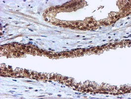 CYP17 / CYP17A1 Antibody - IHC of paraffin-embedded Carcinoma of Human prostate tissue using anti-CYP17A1 mouse monoclonal antibody. (Heat-induced epitope retrieval by 10mM citric buffer, pH6.0, 100C for 10min).