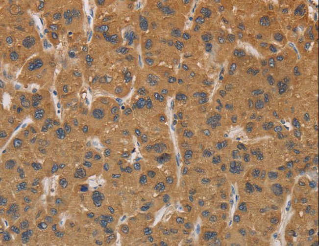 CYP17 / CYP17A1 Antibody - Immunohistochemistry of paraffin-embedded Human gastric cancer using CYP17A1 Polyclonal Antibody at dilution of 1:30.