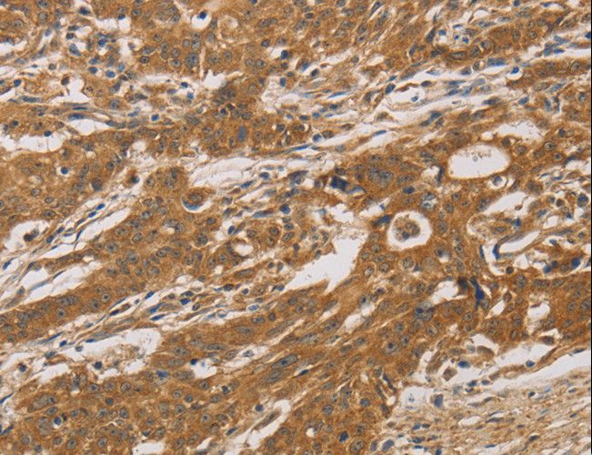 CYP17 / CYP17A1 Antibody - Immunohistochemistry of paraffin-embedded Human gastric cancer using CYP17A1 Polyclonal Antibody at dilution of 1:30.