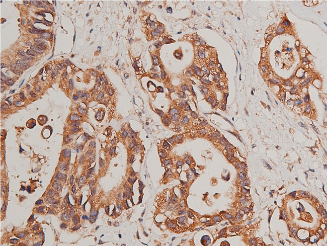 CYP17 / CYP17A1 Antibody - 1:50 staining human colon carcinoma tissue by IHC-P. The tissue was formaldehyde fixed and a heat mediated antigen retrieval step in citrate buffer was performed. The tissue was then blocked and incubated with the antibody for 1.5 hours at 22°C. An HRP conjugated goat anti-rabbit antibody was used as the secondary.