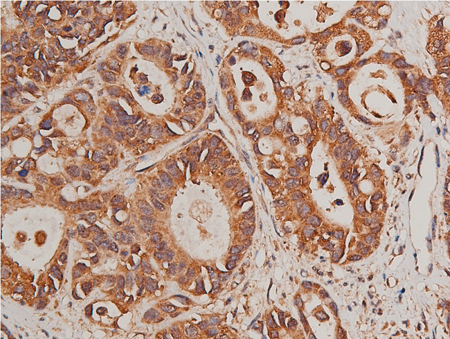 CYP17 / CYP17A1 Antibody - 1:50 staining human colon carcinoma tissue by IHC-P. The tissue was formaldehyde fixed and a heat mediated antigen retrieval step in citrate buffer was performed. The tissue was then blocked and incubated with the antibody for 1.5 hours at 22°C. An HRP conjugated goat anti-rabbit antibody was used as the secondary.