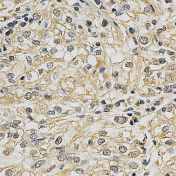 CYP19 / Aromatase Antibody - Immunohistochemistry of paraffin-embedded human kidney cancer using CYP19A1 antibody at dilution of 1:200 (x400 lens)