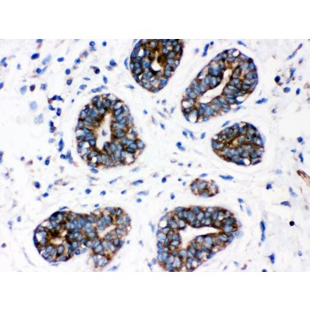 CYP1A1 Antibody - CYP1A1 antibody IHC-paraffin. IHC(P): Human Mammary Cancer Tissue.