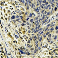 CYP1A1 Antibody - Immunohistochemical analysis of Cytochrome P450 1A1 staining in human esophageal cancer formalin fixed paraffin embedded tissue section. The section was pre-treated using heat mediated antigen retrieval with sodium citrate buffer (pH 6.0). The section was then incubated with the antibody at room temperature and detected using an HRP conjugated compact polymer system. DAB was used as the chromogen. The section was then counterstained with hematoxylin and mounted with DPX.