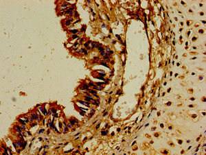 CYP1A1 Antibody - Immunohistochemistry image of paraffin-embedded human colon cancer at a dilution of 1:100