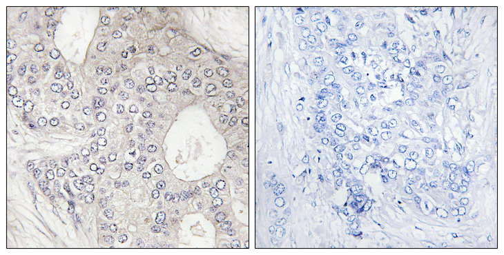 CYP1A2 Antibody - Immunohistochemistry analysis of paraffin-embedded human breast carcinoma tissue, using Cytochrome P450 1A2 Antibody. The picture on the right is blocked with the synthesized peptide.