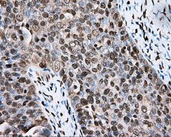 CYP1A2 Antibody - IHC of paraffin-embedded Adenocarcinoma of ovary tissue N93ing anti-CYP1A2 mouse monoclonal antibody. (Dilution 1:50).